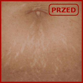 efekty emerge odmładzanie usuwanie zmarszczek blizn poznań laser frakcyjny