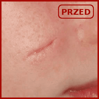 efekty emerge odmładzanie usuwanie zmarszczek blizn poznań laser frakcyjny