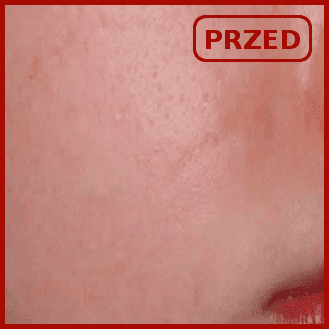 efekty emerge odmładzanie usuwanie zmarszczek blizn poznań laser frakcyjny