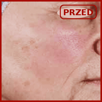 efekty emerge odmładzanie usuwanie zmarszczek blizn poznań laser frakcyjny