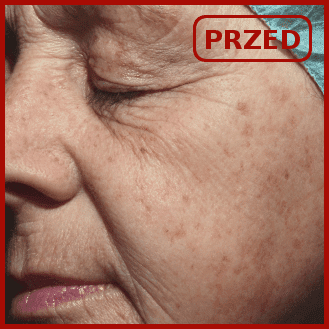 efekty emerge odmładzanie usuwanie zmarszczek blizn poznań laser frakcyjny